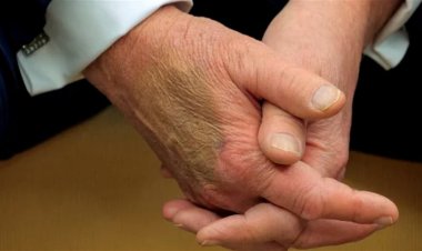 توضيح حول الكدمات على يد ترامب