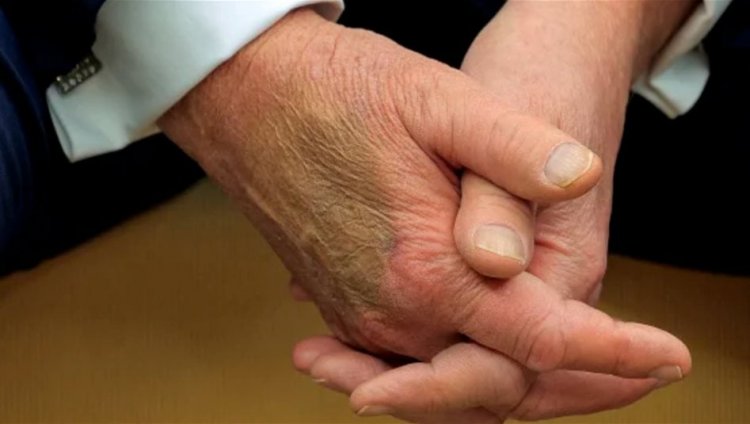 توضيح حول الكدمات على يد ترامب